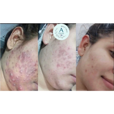 crema para acné